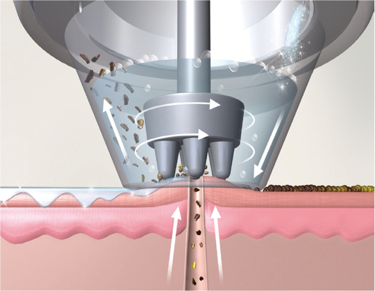 ハイドラパール 吸引